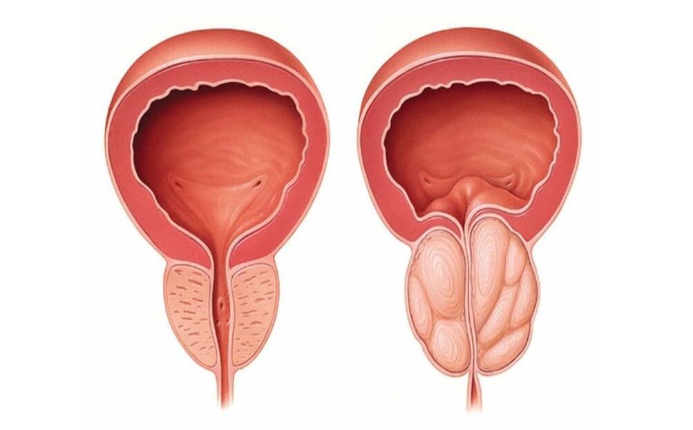 normální a zanícená prostata