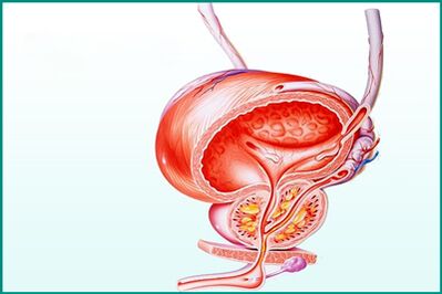 Zánět prostaty u akutní prostatitidy je omezením pro sex