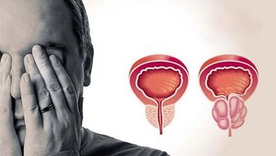 Důvody rozvoje prostatitidy u mužů