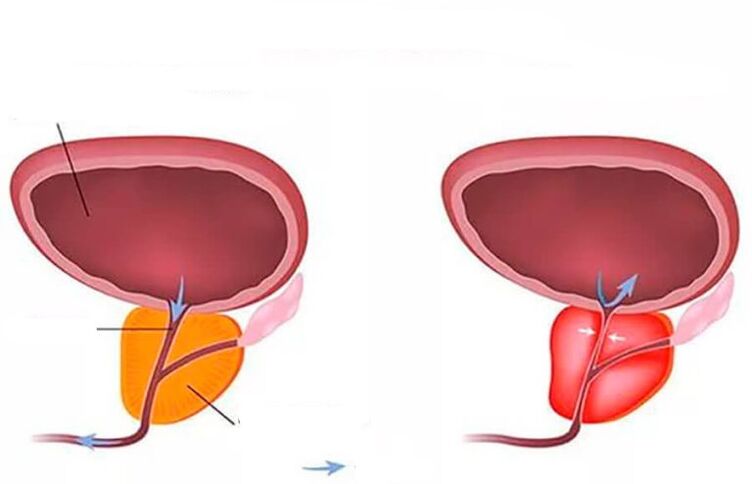normální a zanícená prostata