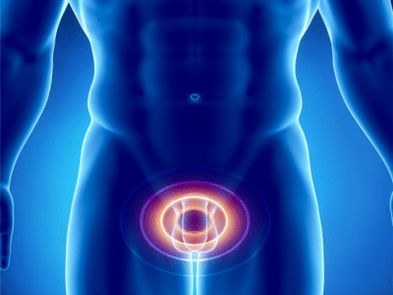 Prostatitida – zánět prostaty u muže