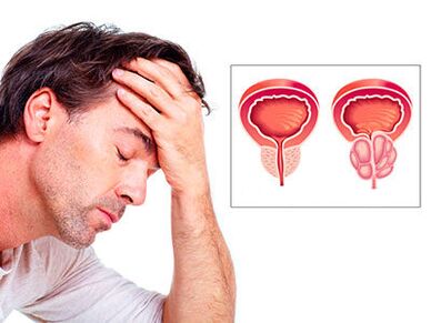 Příznaky prostatitidy muže znepokojují