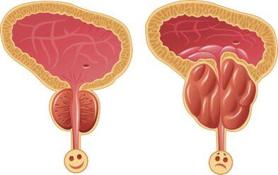 Zdravá a zanícená mužská prostata