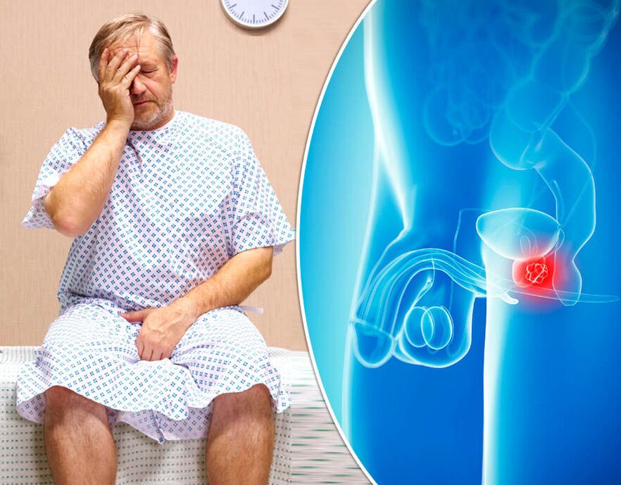 U muže s prostatitidou je diagnostikována nemoc