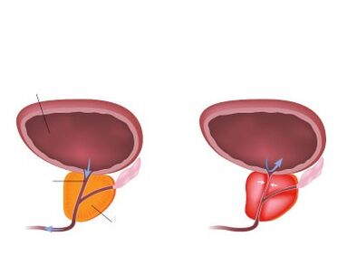 Normální a zanícená prostata
